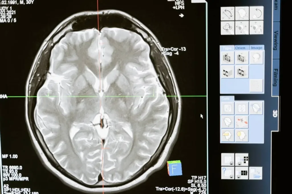traumatic brain injury symptoms