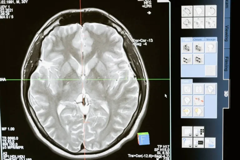 traumatic brain injury symptoms