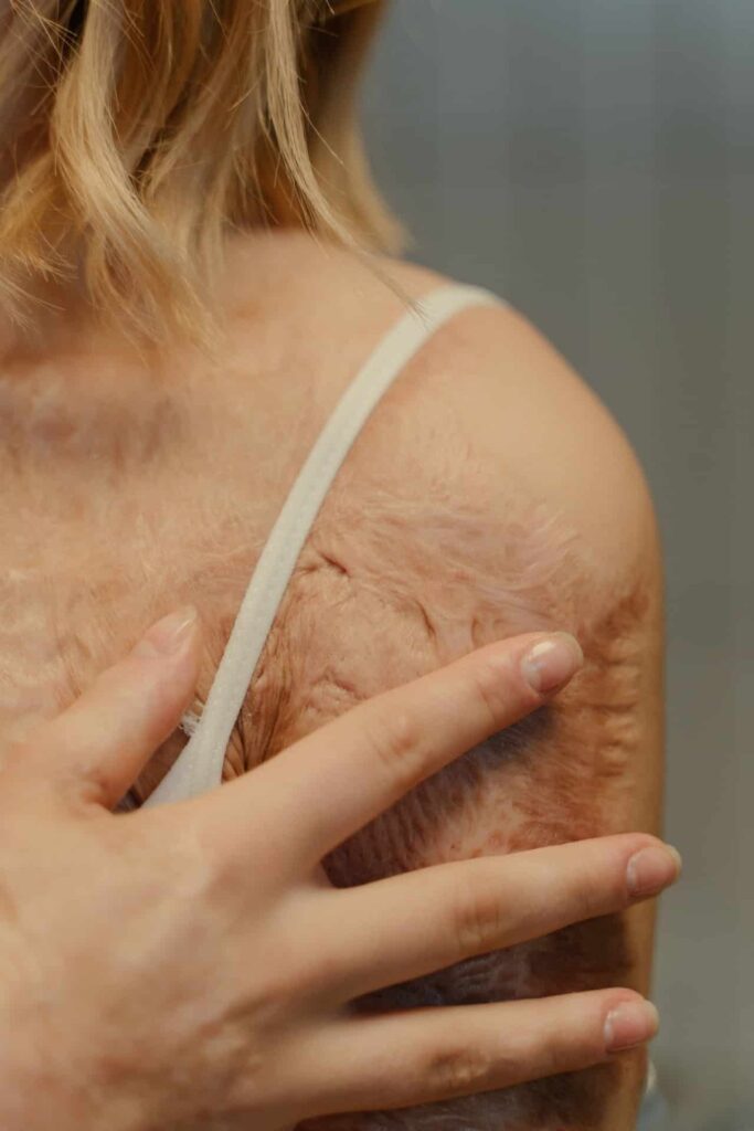 Burn INJURY ATTORNEY